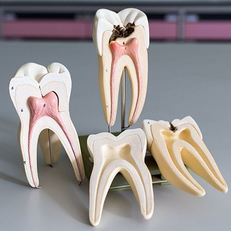 Model of the inside of a tooth throughout the root canal process