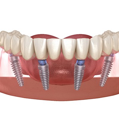 Four dental implants in Rancho Bernardo and denture