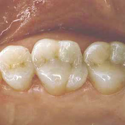 Clsoeup of patient's smile after tooth colored filling treatment