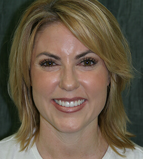 Woman with healthy beautiful smile after restorative dentistry