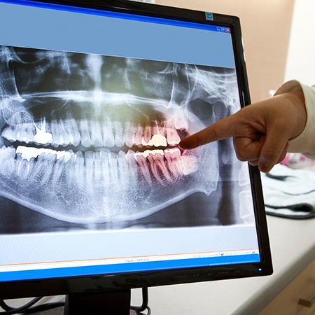 Digital dental x-rays on computer screen