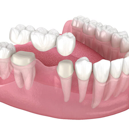 3D render of a traditional dental bridge