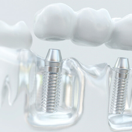 picture of an implant bridge
