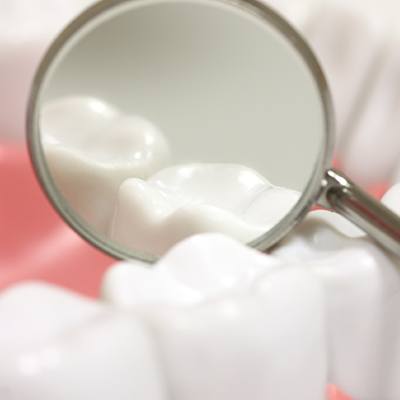 Close up of smile with dental sealants