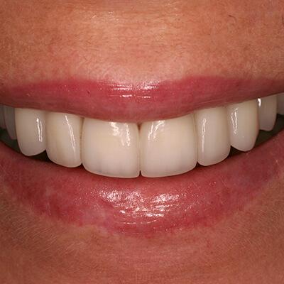Patient's smile after porcelain veneers