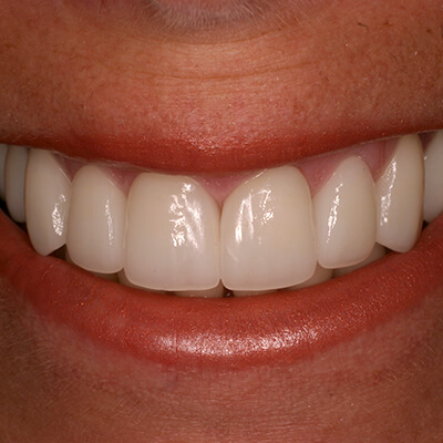 Closeup of smile after metal free dental restorations