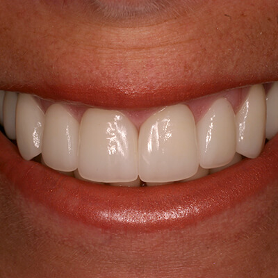 Close up of smile after metal free dental restorations