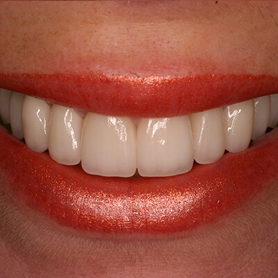 Closeup of smile after dental bonding