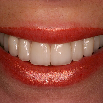 Close up of smile after dental bonding