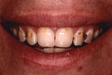 Front teeth with several dark areas of decay