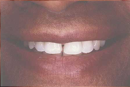 Smile with large gap between front teeth