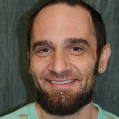 closeup of man smiling after getting dentures