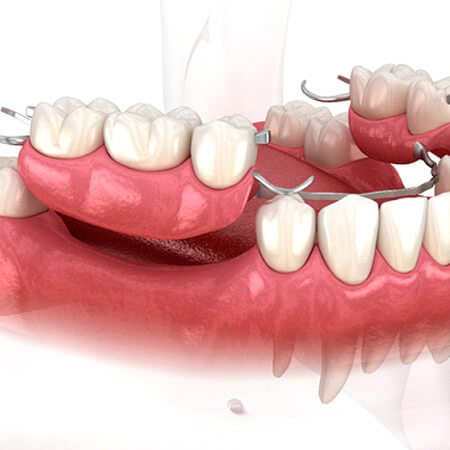 3D graphic of partial dentures