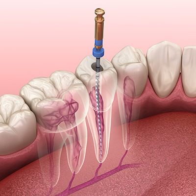 Illustration of root canal treatment for lower tooth