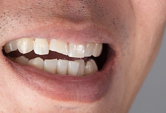 Closeup of smile chipped front tooth