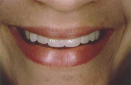 Gorgeous white smile with all-porcelain restorations
