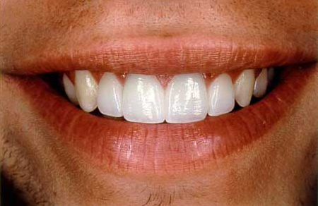Smile repaired to natural beauty with empress porcelain crowns and veneers