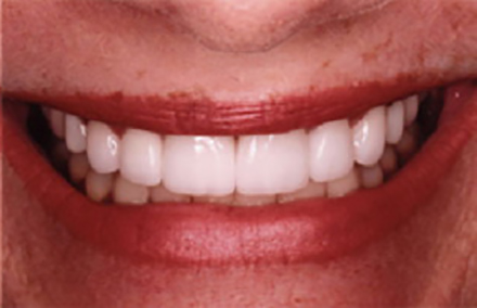 Gapped smile repaired with eris crowns and porcelain veneers