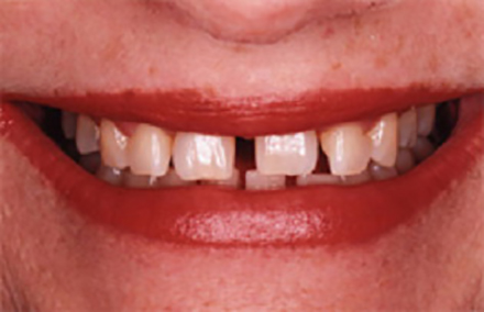 Smile with large gaps between front teeth