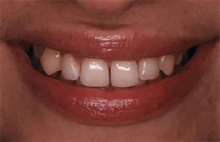 Smile with unevenly spaced discolored teeth