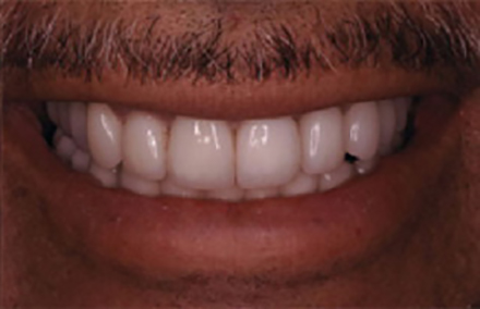 Empress 2 and porcelain to gold crowns repairing smile with large gaps