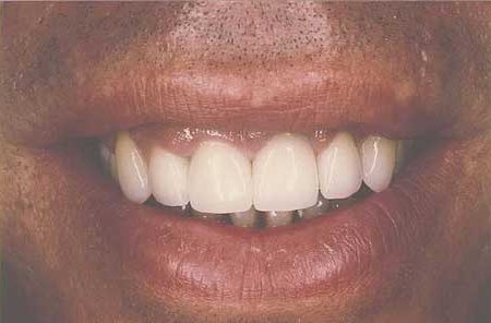 Empress veneer-crowns correcting gaps in teeth