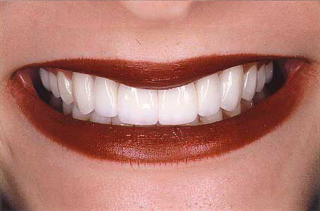 Empress veneer-crowns and veneer onlays repairing unevenly spaced smile