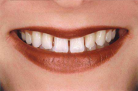 Teeth unevenly spaced after orthodontic care