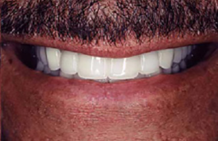Top and bottom teeth repaired with dental empress crowns and empress veneer crowns