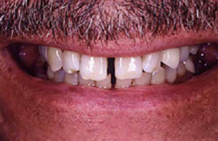 Large gap between front top and bottom teeth