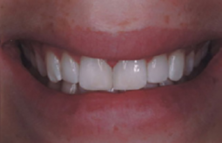 Beautiful smile perfected with composite restorations