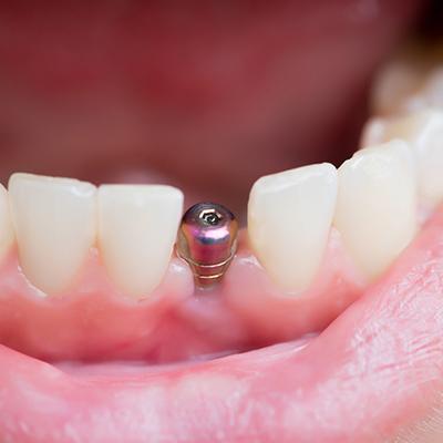 Dental implant in Rancho Bernardo on lower arch