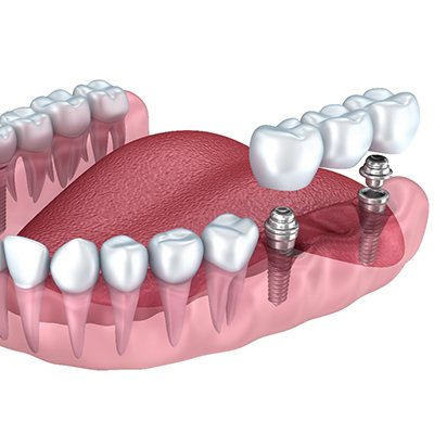 Implant bridge in Rancho Bernardo on lower arch