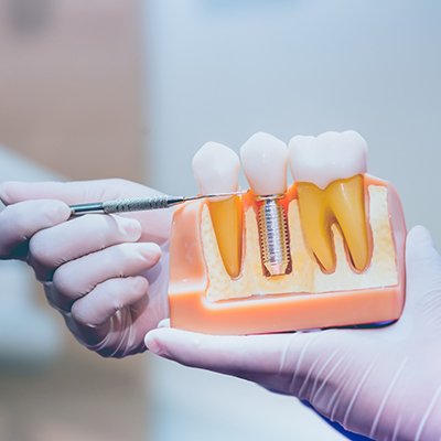 Dentist holding model of dental implant in Rancho Bernardo