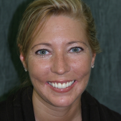 Close up of smile during teeth cleaning