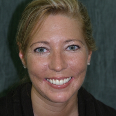 Closeup of smile during teeth cleaning