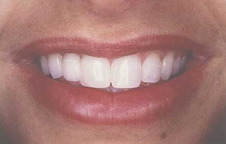 Woman's smile flawlessly repaired with porcelain veneer-to-resin bridge