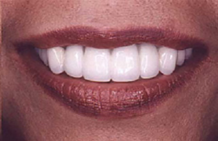 Woman with bright white beautiful smile after empress porcelain veneers and porcelain to gold dental crowns