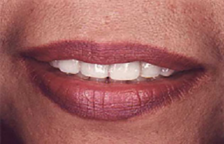 Woman with stubby looking front teeth