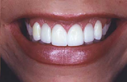 Smile with perfectly shaped teeth and gums after all ceramic empress two bridges