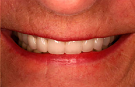 Beautifully reshaped smile with Empress veneers lava dental crowns and porcelain to gold bridges