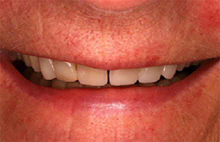 Short front teeth with large gap between them