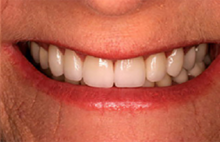 Gorgeous smile with brilliant white natural Empress veners lava crowns and porcelain to gold bridge restorations