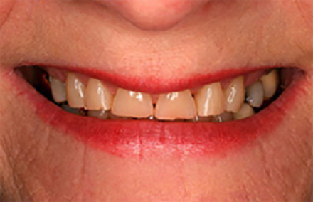 Broken and yellowed smile with gaps between teeth