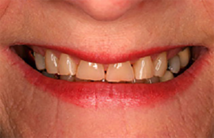 Broken and yellowed smile with gaps between teeth