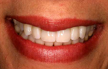 Gorgeous smile with white straight teeth after composite resin and zirconia porcelain restorations