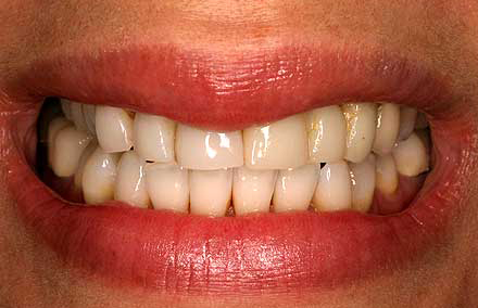 Crowded smile with worn down front teeth