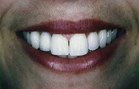 Natural looking all porcelain bonded fixed bridge tooth replacement