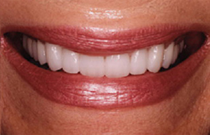 Bright white smile with Empress veneers and porcelain to gold restorations