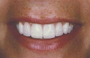 Crooked smile enhanced with all porcelain veneers